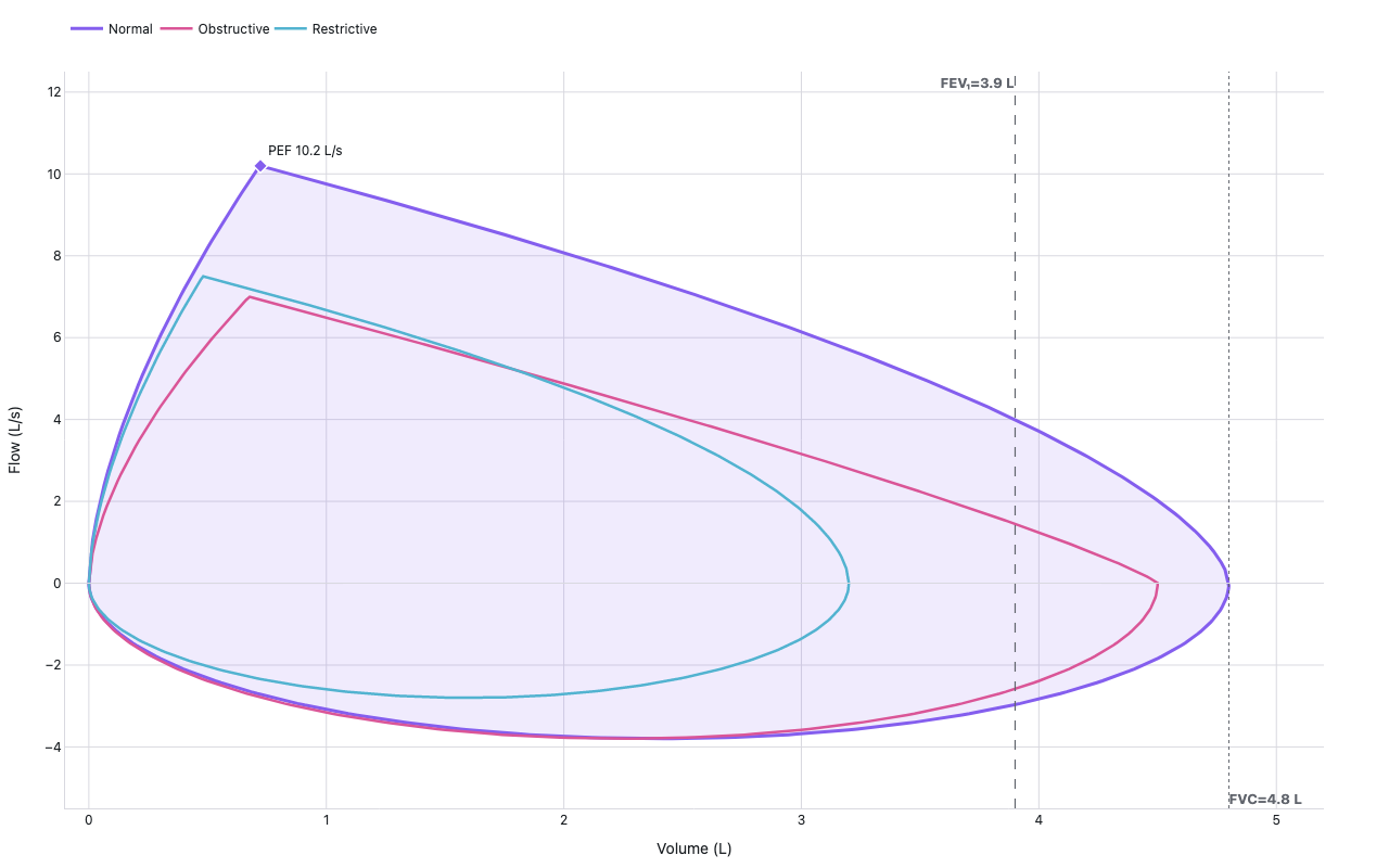 Normal spirometry flow-volume loop showing expiratory limb rising steeply to a peak flow of 10.2 L/s then declining to zero at FVC of 4.8 L, with inspiratory return limb below the x-axis