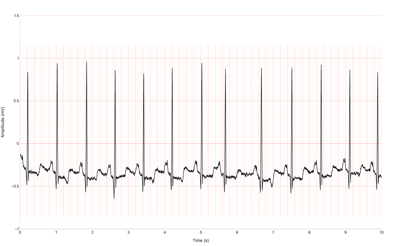 Two-and-a-half second Lead II ECG strip from PhysioNet MIT-BIH record 100, plotted in black on a pink ECG grid with 0.2s/0.5mV major divisions, showing normal sinus rhythm with clear P, QRS, and T waves