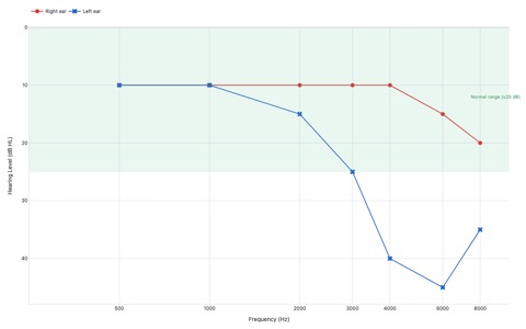Audiogram showing NHANES 2017-18 population median hearing thresholds at 500–8000 Hz for right ear (red circles) and left ear (blue X marks), with the y-axis reversed per audiogram convention showing 0 dB HL at top