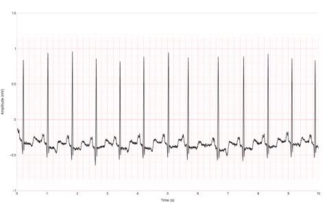 Two-and-a-half second Lead II ECG strip from PhysioNet MIT-BIH record 100, plotted in black on a pink ECG grid with 0.2s/0.5mV major divisions, showing normal sinus rhythm with clear P, QRS, and T waves
